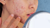 Your Guide to Flawless Skin: The Power of Top Acne-Fighting Ingredients
